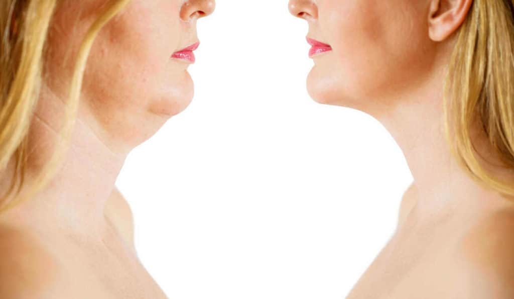 Double Chin treatment Ruislip Common before and after results