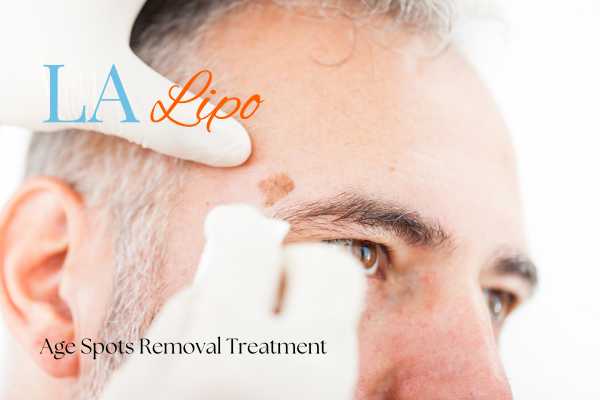 What Are the Most Effective Treatments for Age Spots Ruislip Common?