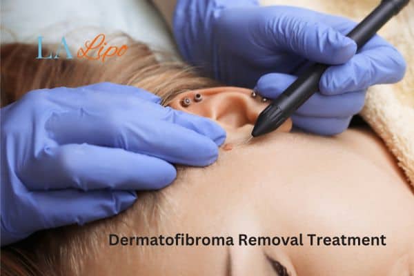 Dermatofibroma Removal Treatment Ruislip Common