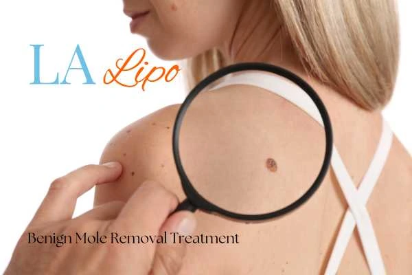 Woman having her inspection of blemish before mole removal Ruislip Common