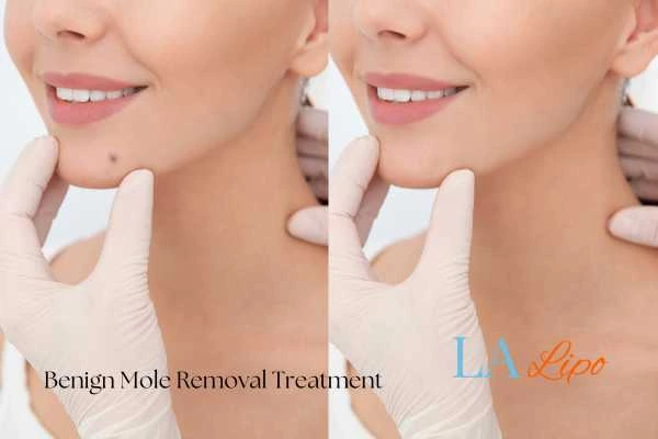 Before and after mole removal Ruislip Common treatment