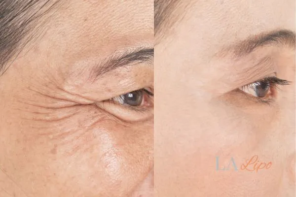 Before and after results of woman - HI-fu wrinkles reduction treatment Ruislip Common
