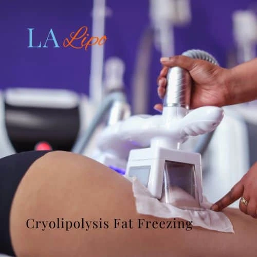 fat freezing - Cryolipolysis Ruislip Common