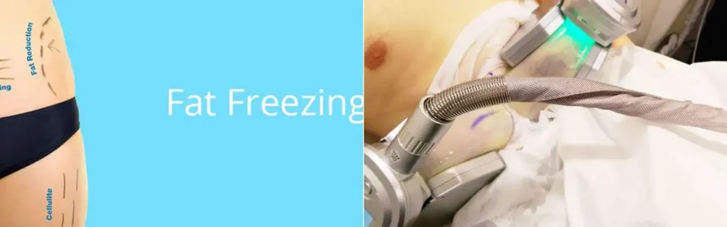multi areas of a persons body having coolsculpting Ruislip Common treatment