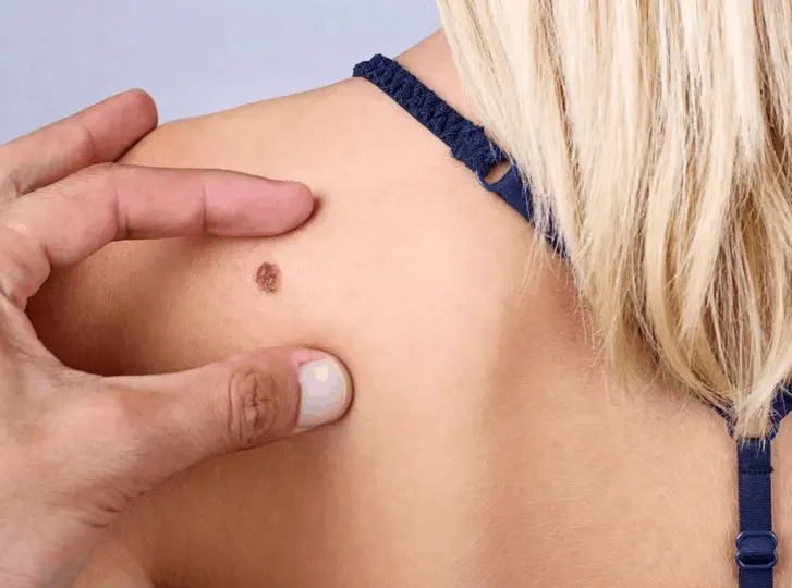 woman having mole removal Ruislip Common consultation before treatment.