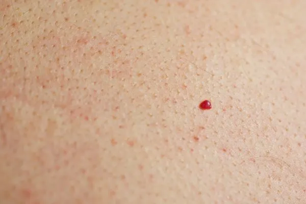 close up of a cherry angioma Ruislip Common