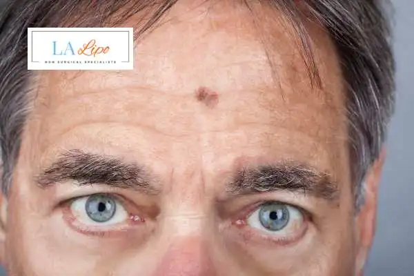 Solar Lentigo Removal Ruislip Common image of man with mark on his forehead