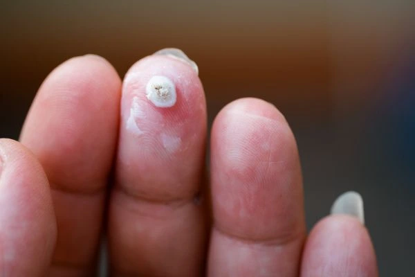 wart on person finger - cryotherapy to treat from LA LIPO Ruislip Common