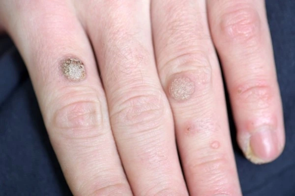 photo of warts on person hand - see wart removal Ruislip Common from LA LIPO