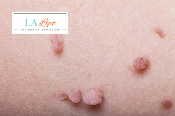 Does cryopen skin tag removal Ruislip Common hurt? Find out now call our team today!