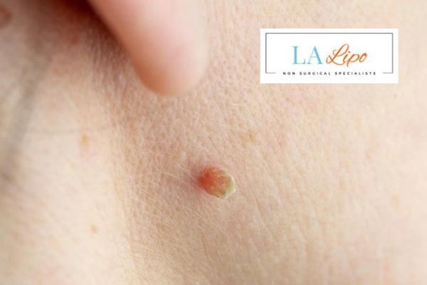 Book skin tag removal Ruislip Common today speak to our team now!