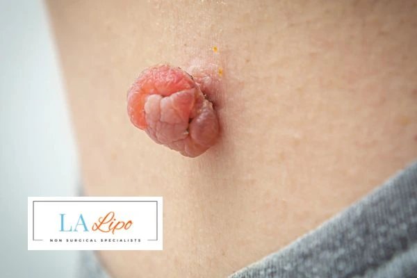 Interested in skin tag removal Ruislip Common? Concerned about the pain? Find out more today!