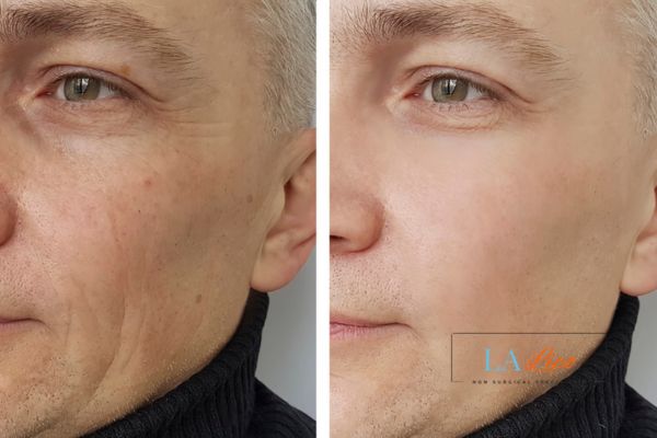 See the amazing results of Morpheus8 Treatment Ruislip Common!