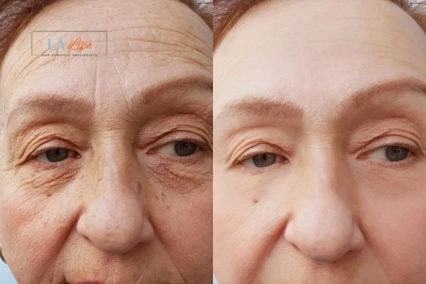The powerful benefits of Morpheus8 Treatment Ruislip Common - Call Our team today!