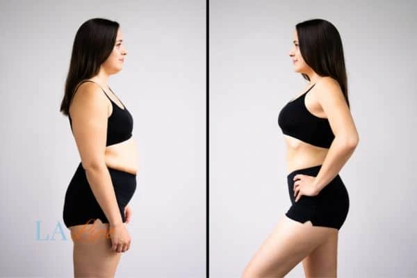 Picture of womans before and after using LA-EMS body sculpting to improve her core strength Ruislip Common