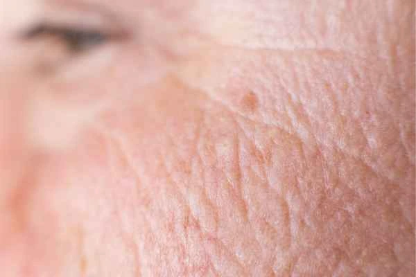 close up picture of a woman's face showing an age spot Ruislip Common