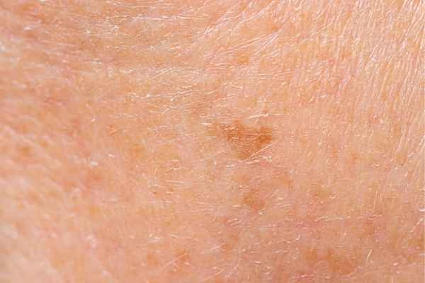 close up picture of age spots Ruislip Common