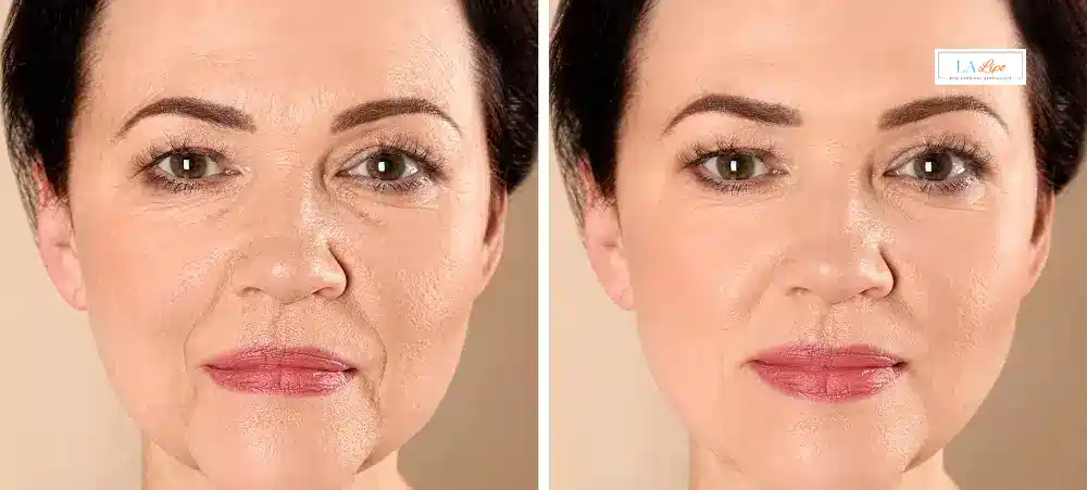 How Long Does It Take to See Results and How Long Do They Last Ruislip Common?