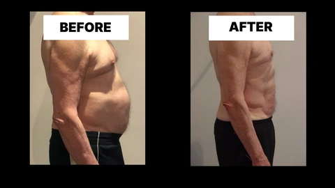 What Symptoms Can Diastasis Recti Cause in Men? Weak Core, Back Pain and Poor Posture Ruislip Common